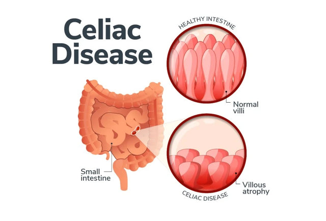 what genes determines celiac disease